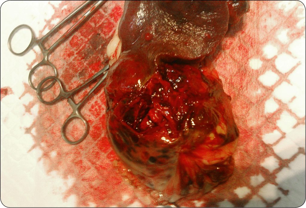 WWP_4_18_HEMANGIOSARCOMA_MASKOWANA_PRZEZ_BABESIOSIS_CANUM_RYC_4 śledziony