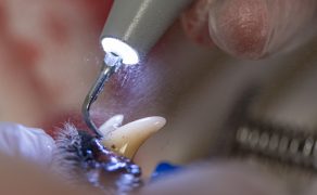 Znieczulenie ogólne do zabiegu sanacji jamy ustnej z ekstrakcją zębów u pacjenta z chorobą zwyrodnieniową zastawki mitralnej (dwudzielnej). Opis przypadku