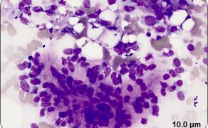 WWP_10-13_Cytologia_nowotworow_mezenchymalnych_fot8