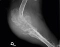WWP_1_2_12_Diagnostyka_zmian_agresywnych_kosci_w_badaniu_radiologicznym_i_ultrasonograficznym_ryc2