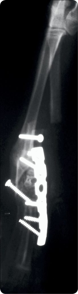 WWP_4_12_Piotr_Trebacz_OPERACYJNE_LECZENIE_ROZSZCZEPU_DLONI_I_NADGARSTKA_RYC_7