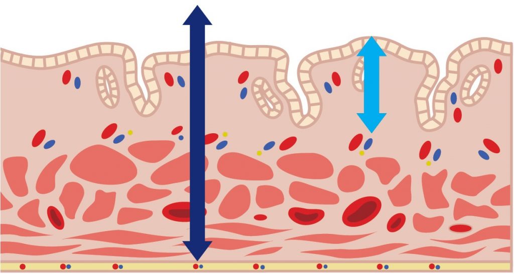 endometritis