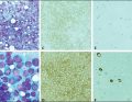 WWP_10_23_Jaroslaw_Balcerzak_LECZENIE_CHLONIAKA_ROZLANEGO_Z_DUZYCH_LIMFOCYTOW_RYC_1