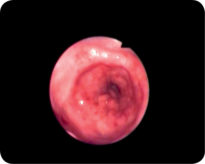 WWP_3_10_Marcin_Jankowski_PRZEROSTOWE_ZWEZENIE_ODZWIERNIKA_U_PSA_RYC_2 przerostowe zwężenie odźwiernika