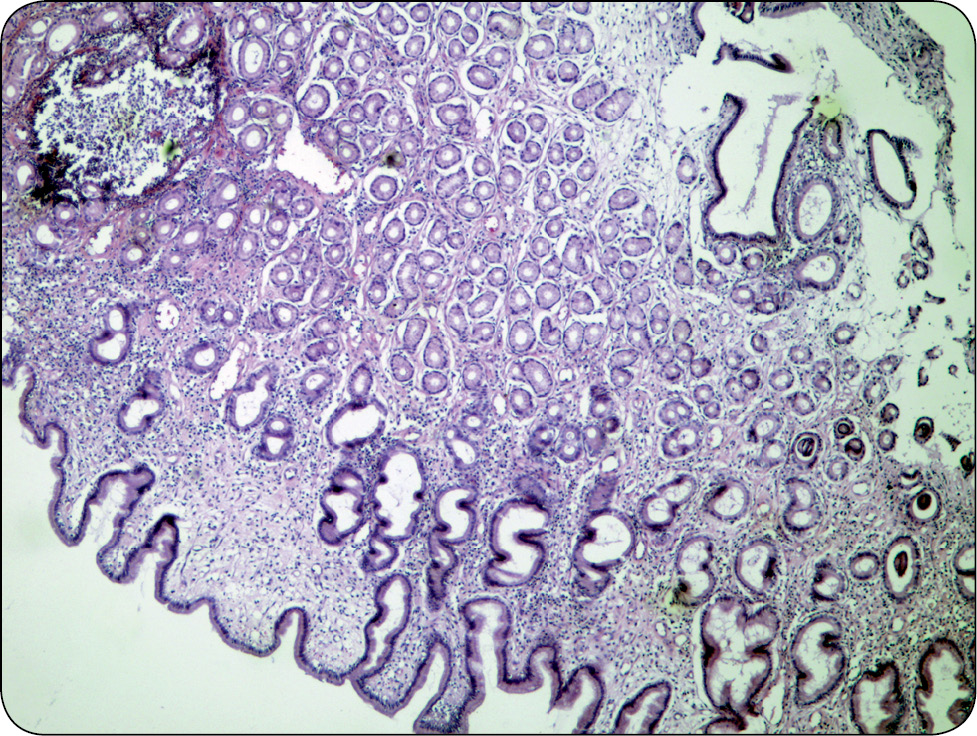 WWP_3_10_Marcin_Jankowski_PRZEROSTOWE_ZWEZENIE_ODZWIERNIKA_U_PSA_RYC_3 przerostowe zwężenie odźwiernika