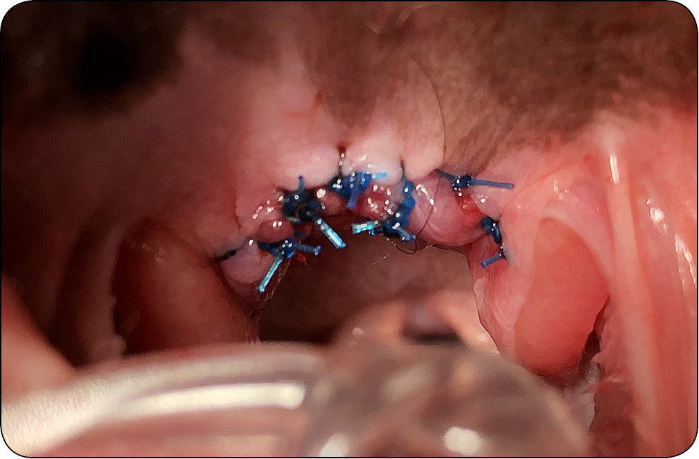 WWP_1-2_24_Pawel_Adam_Mucha_POWIKLANIE_PO_ZABIEGACH_PALATOPLASTYKI_RYC_8