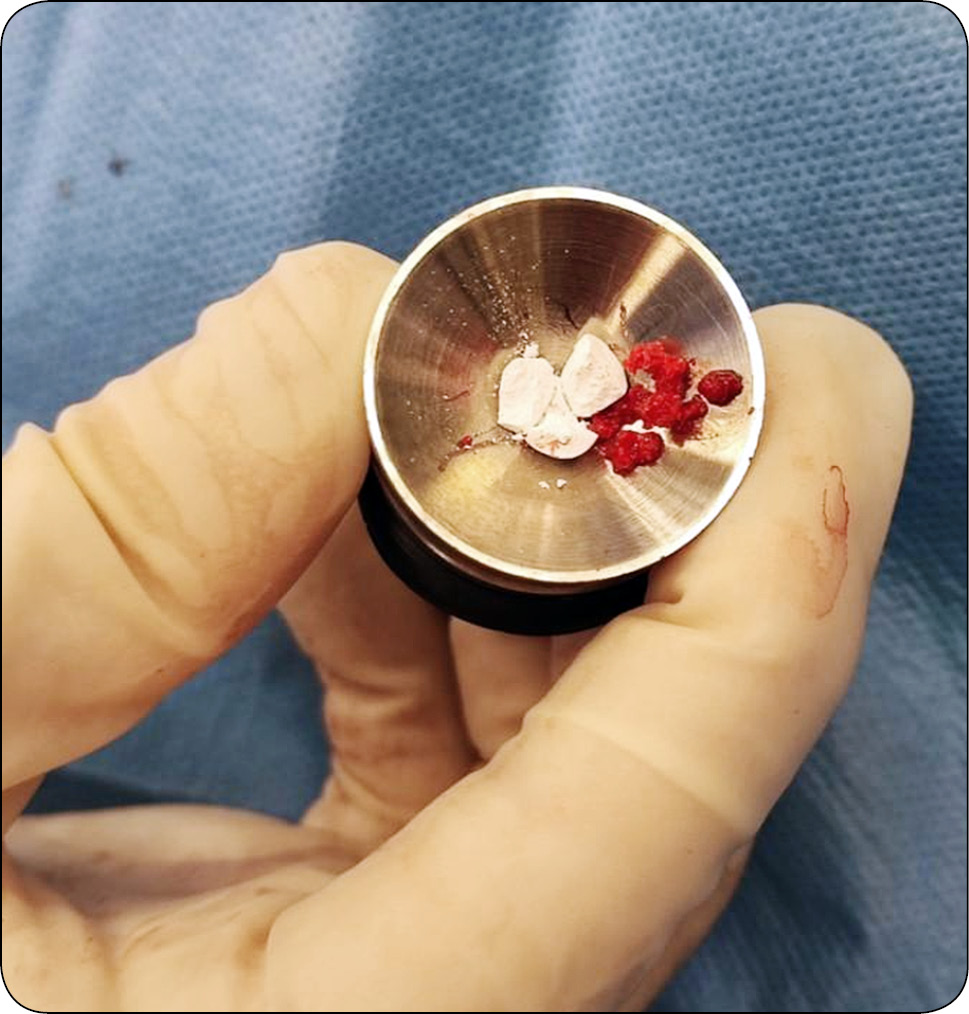 WWP_1-2_24_Hanna_Ziemak_ Przegląd resorbowalnych materiałów kościozastępczych