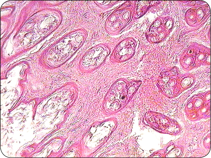 ENDO-DERMA_23_Maria_Katkiewicz_NOWOTWORY_MESZKOW_WLOSOWYCH_RYC_1 mieszków włosowych