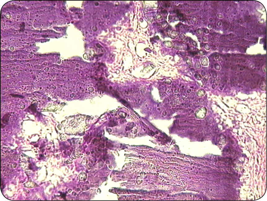 ENDO-DERMA_23_Maria_Katkiewicz_NOWOTWORY_MESZKOW_WLOSOWYCH_RYC_11 mieszków włosowych