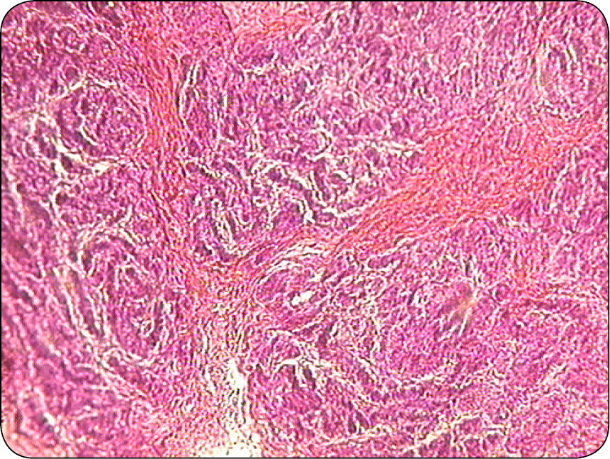 ENDO-DERMA_23_Maria_Katkiewicz_NOWOTWORY_MESZKOW_WLOSOWYCH_RYC_4 mieszków włosowych