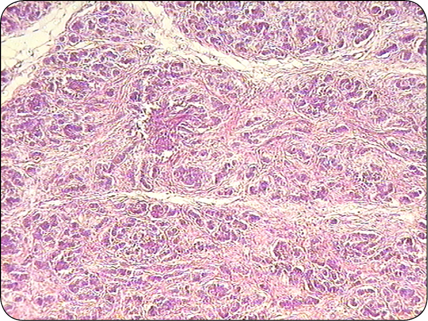 ENDO-DERMA_23_Maria_Katkiewicz_NOWOTWORY_MESZKOW_WLOSOWYCH_RYC_5 mieszków włosowych