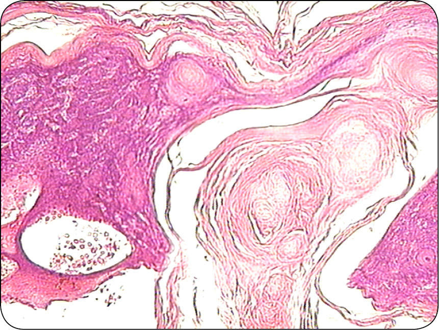 ENDO-DERMA_23_Maria_Katkiewicz_NOWOTWORY_MESZKOW_WLOSOWYCH_RYC_9