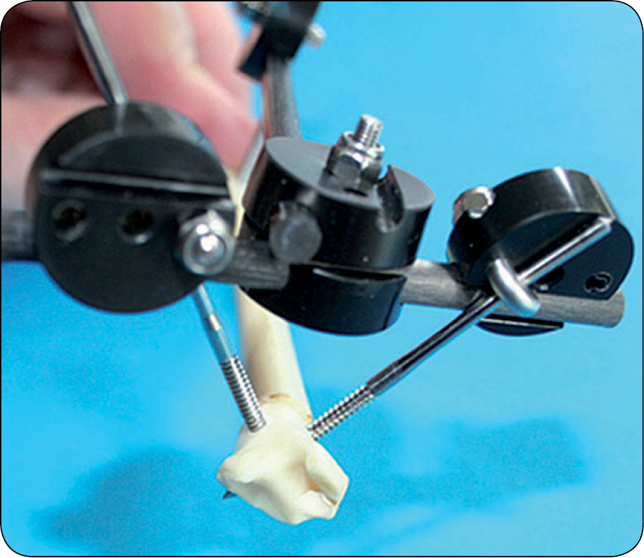 WWP_7-8_24_chirurgia_Gian_Luca_Rovesti_SYSTEM_ZEWNETRZNEJ_STABILIZCJI_LINIOWEJ_POLILOCK_RYC_16_B