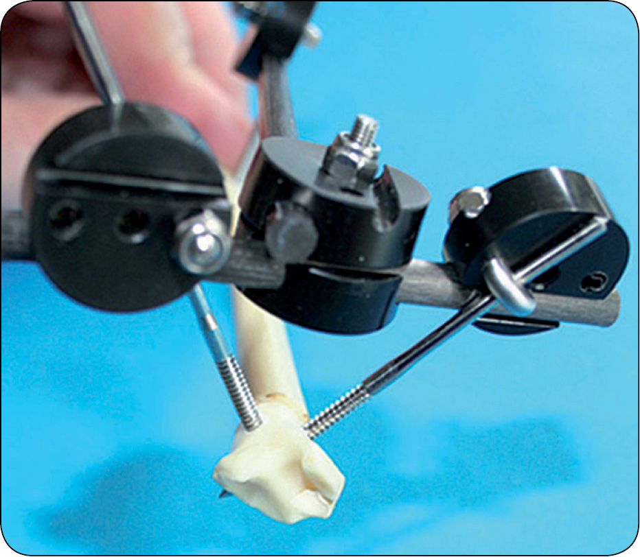 WWP_7-8_24_chirurgia_Gian_Luca_Rovesti_SYSTEM_ZEWNETRZNEJ_STABILIZCJI_LINIOWEJ_POLILOCK_RYC_16_C