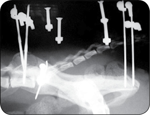 WWP_7-8_24_chirurgia_Gian_Luca_Rovesti_SYSTEM_ZEWNETRZNEJ_STABILIZCJI_LINIOWEJ_POLILOCK_RYC_20_B