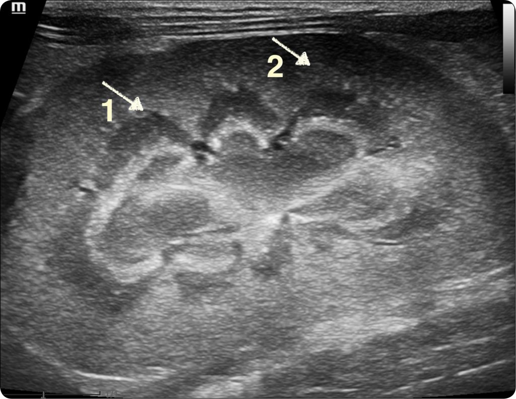 WWP_9_24_Michal_Gruss_ROZNICOWANIE_KOROWO-RDZENIOWE_OBJAW_USG_W_OCENIE_NEREK_RYC_1_B korowo-rdzeniowe