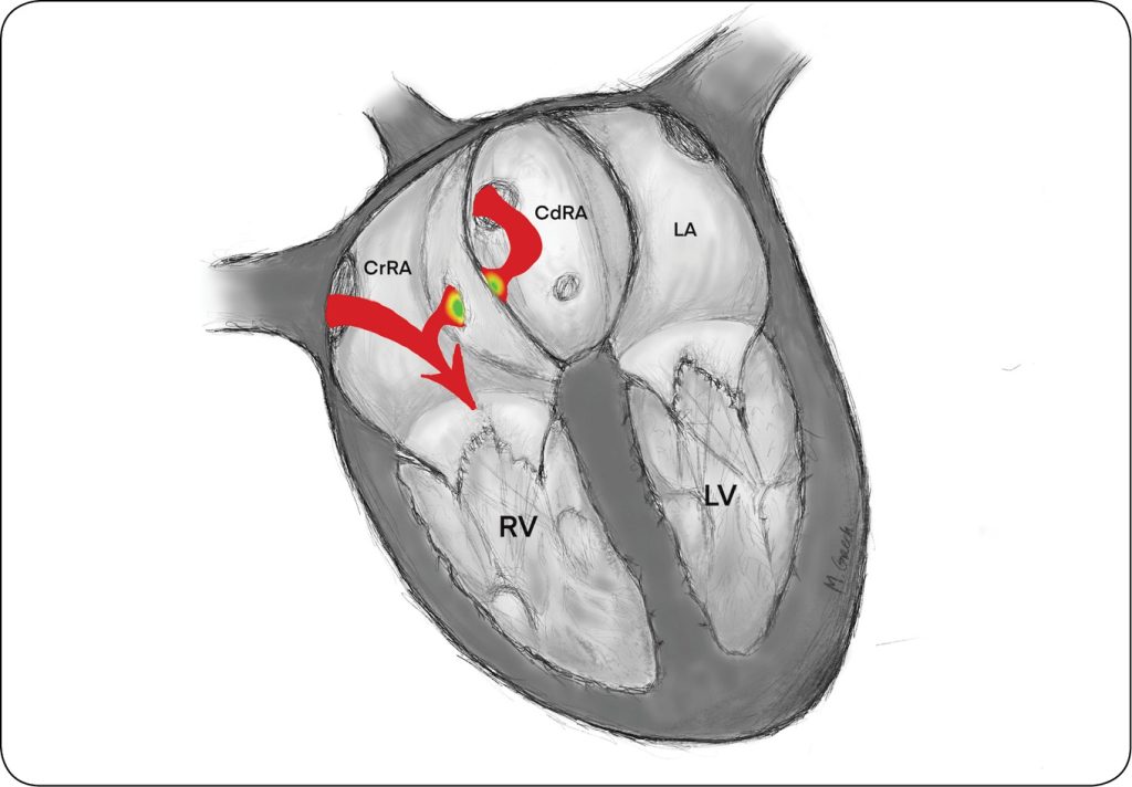 KARDIO_24_Magdalena_Grzech-Wojciechowska_WADY_WRODZONE_SERCA_PRAWEGO_U_PSOW_I_KOTOW_RYC_7 serca
