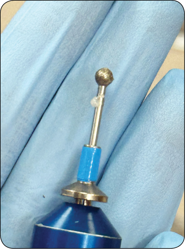 WWP_4_25_okulistyka_Katarzyna_Szulc_OWRZODZENIA_ROGOWKI_KLASYFIKACJA_DIAGNOSTYKA_LECZENIE_RYC_16 rogówki