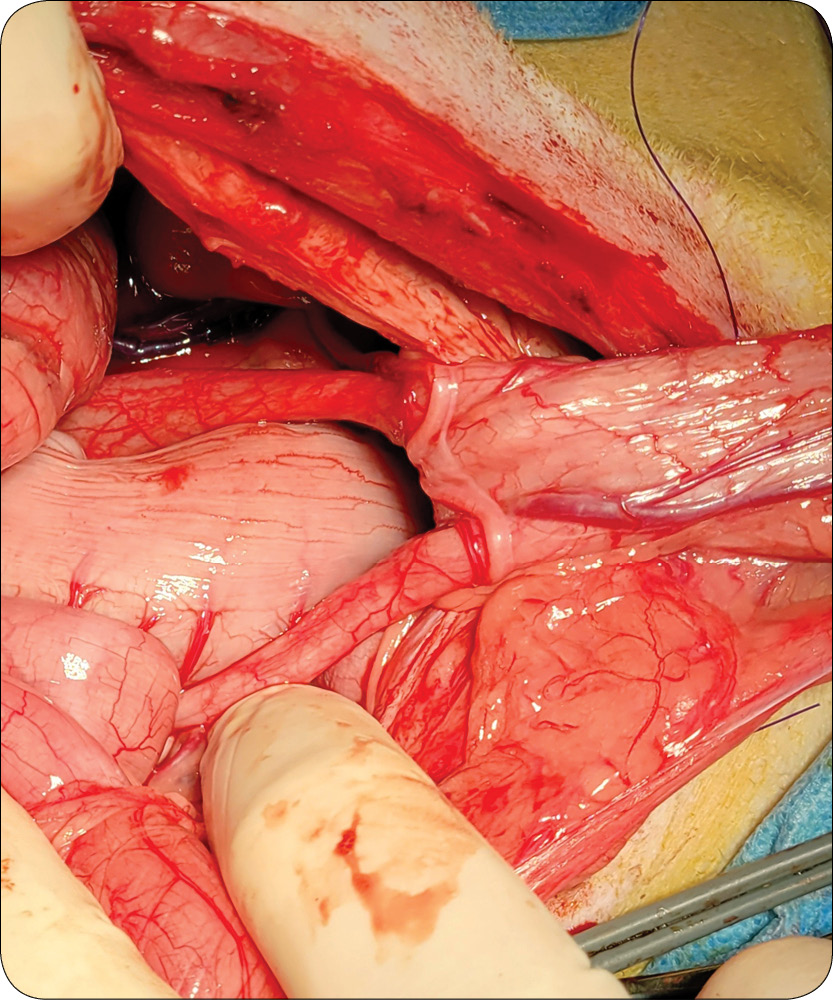 WWP_6_25_chirurgia_Przemyslaw_Adach_EKTOPIA_MOCZOWODOW_U_PSA_RYC_4 Ektopia moczowodów