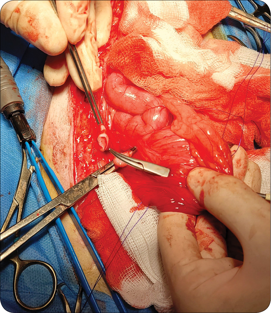 WWP_6_25_chirurgia_Przemyslaw_Adach_EKTOPIA_MOCZOWODOW_U_PSA_RYC_5 Ektopia moczowodów