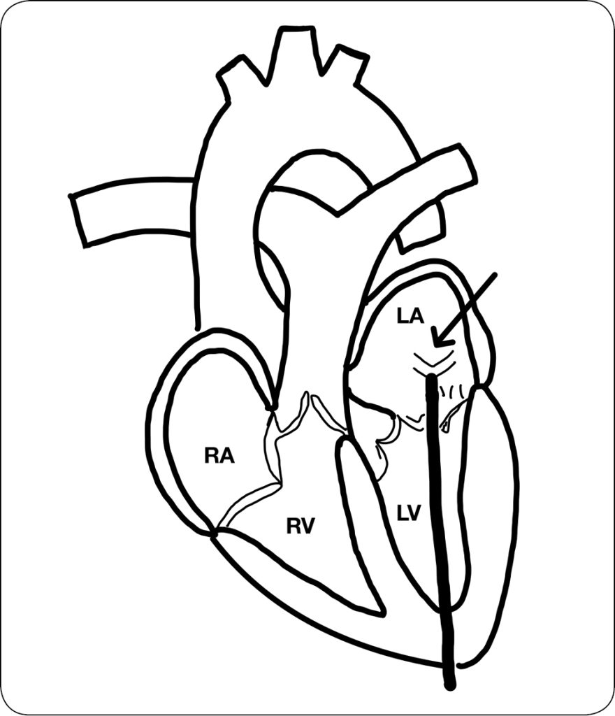 WWP_10_25_kardiologia_Joanna_Bubak_LECZENIE_NIEDOMYKALNOSCI_ZASTAWKI_MITRALNEJ_RYC_3 niedomykalności zastawki mitralnej